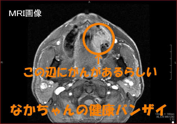 口腔MRI造影axial